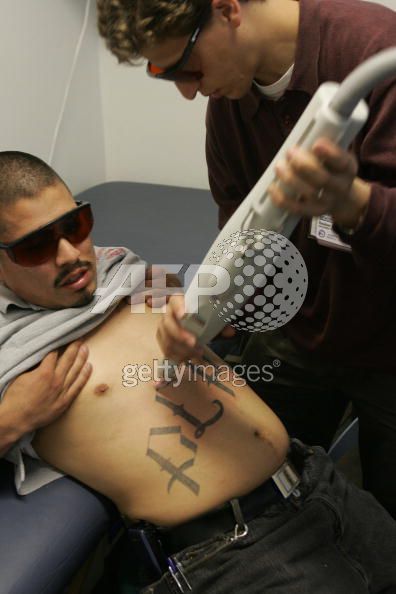 gang tattoo removal