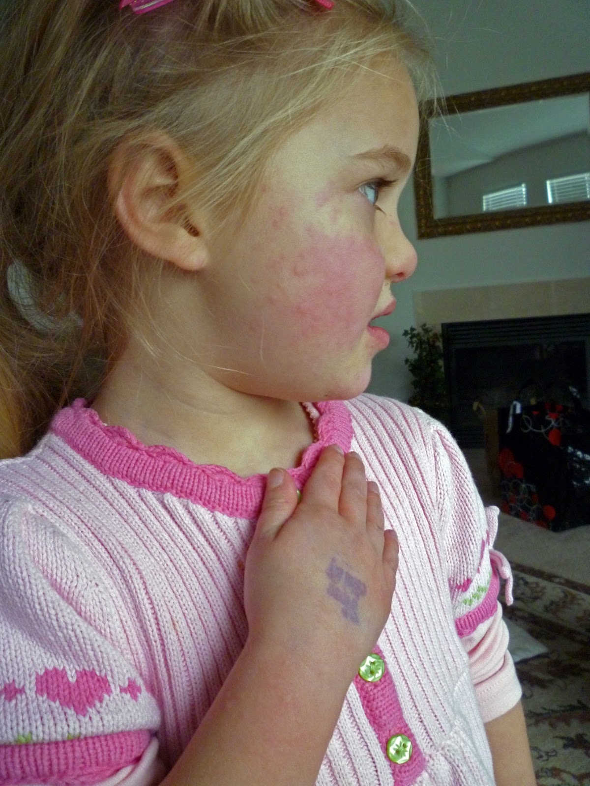 Snow Allergy (Not a Joke)