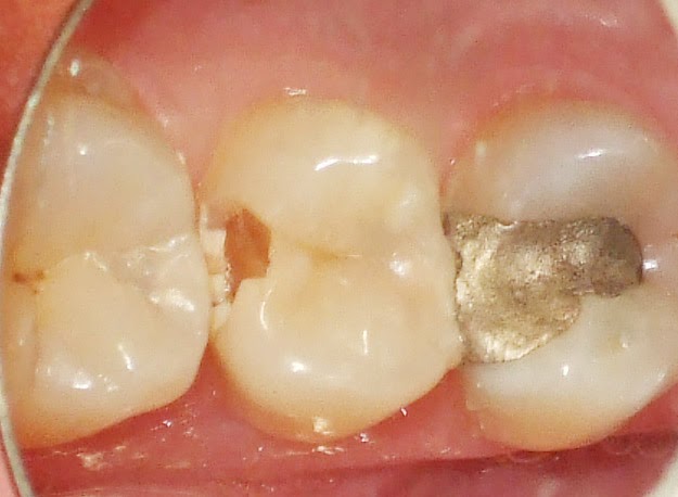 chipped tooth piece decay under line yourself surface floss