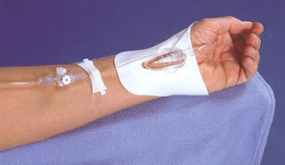 The Arterial Line : Thrombotic complications after radial arterial line placement in