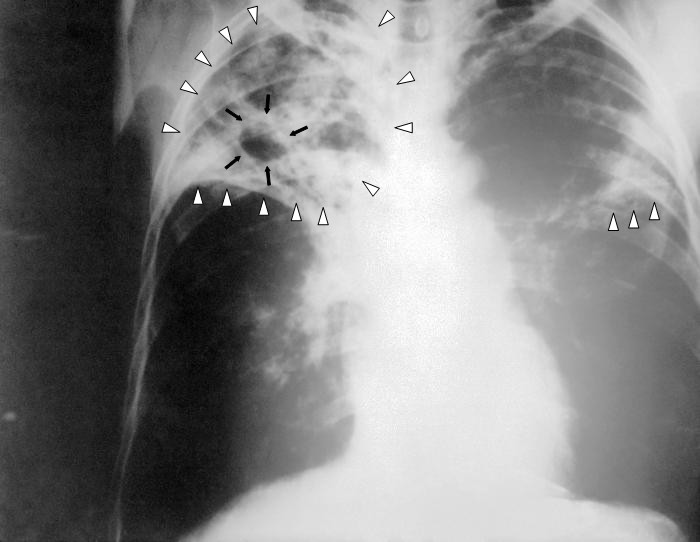 [Tuberculosis-x-ray-1.jpg]