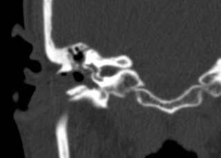 temporal bone fracture ct radiology