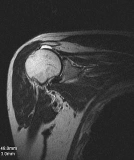 rotator cuff tear mri