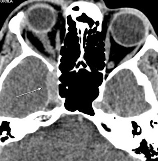 cavernous sinus thrombosis