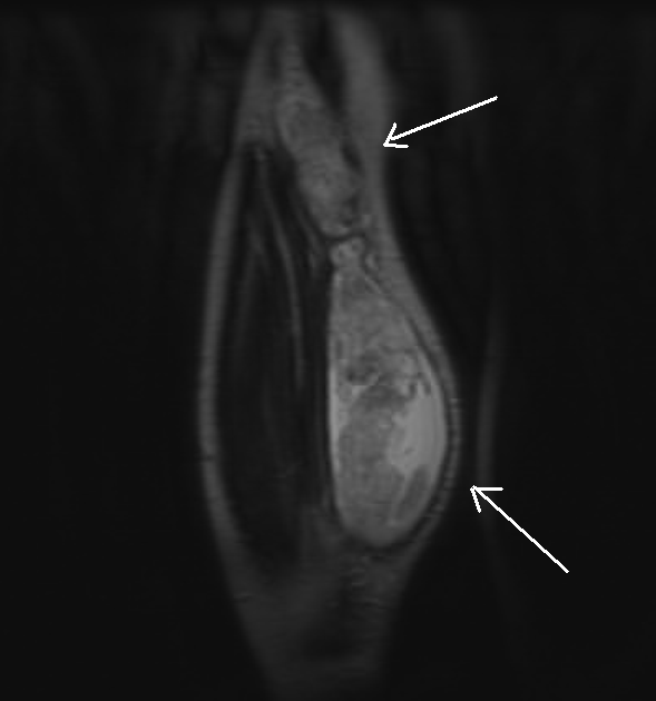 Giant Baker's CystMRI Sumer's Radiology Blog