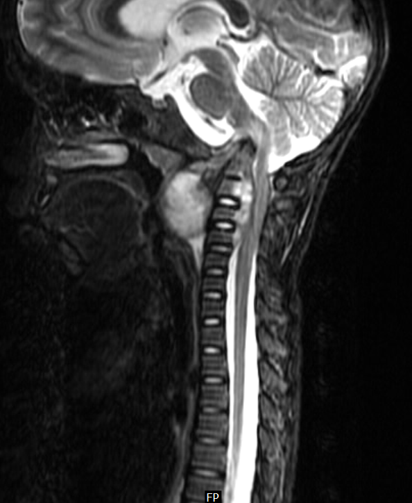 CV Junction Potts SpineMRI Sumer's Radiology Blog