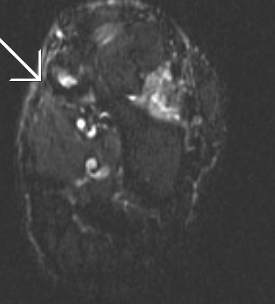 Accessory Navicular Syndrome