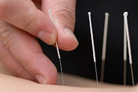 Acupuncture