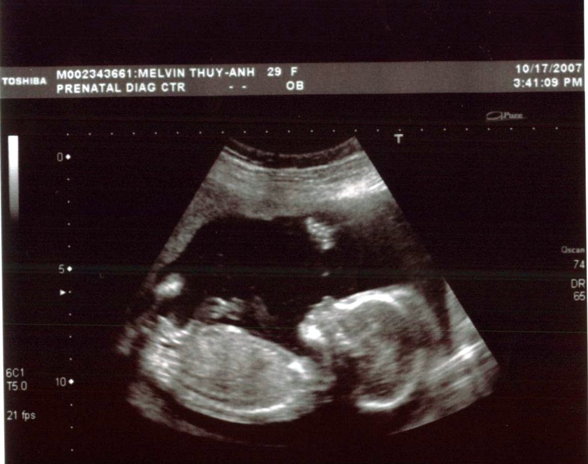 [ultrasound+18wk.jpg]