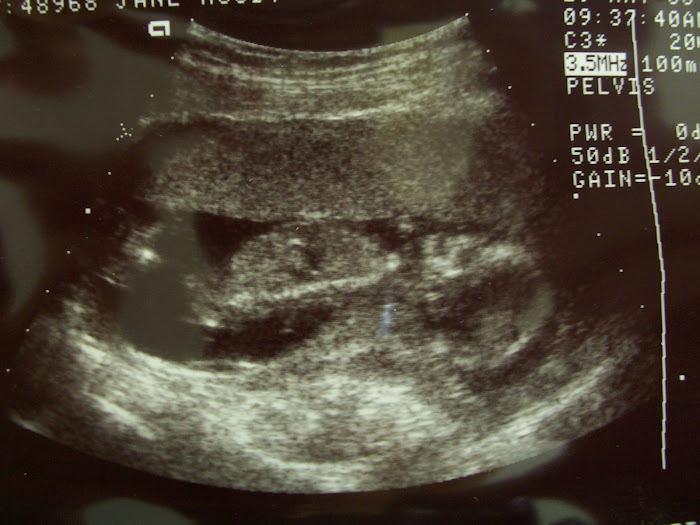 13 Weeks Sonogram 1