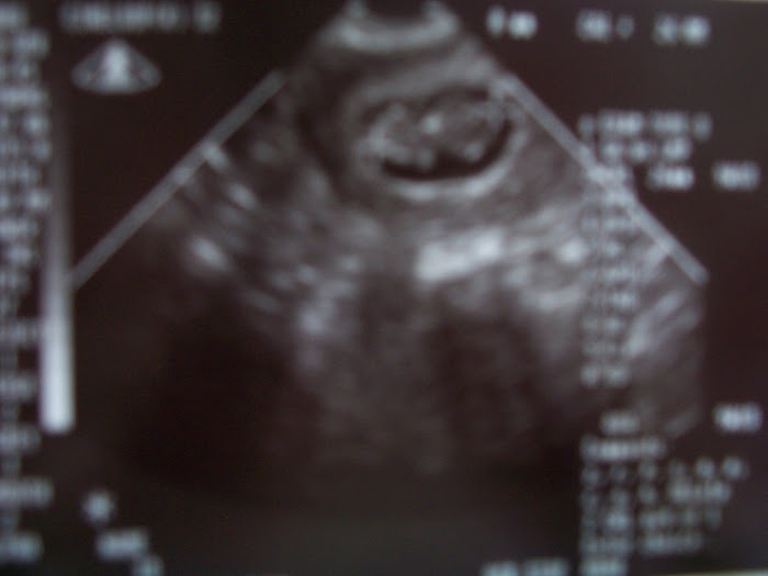 9 Weeks Sonogram 1