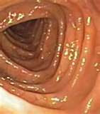 Laxative Abuse and The Colon