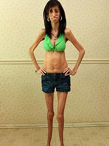 of Lizzie Velasquez