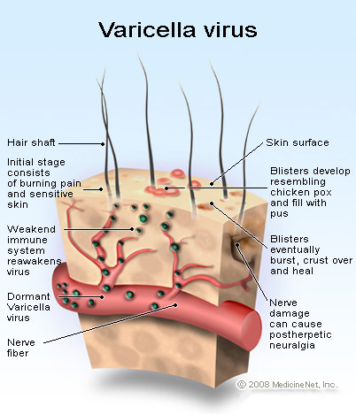 does valtrex shorten shingles