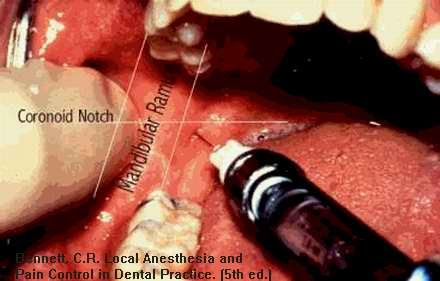 Dentistry Notes: Inferior Alveolar Block