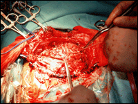 Hemispherectomy Hemispherectomy