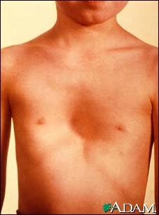 Earth Science: Marfan Syndrome