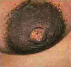 Sore nipples are usually due