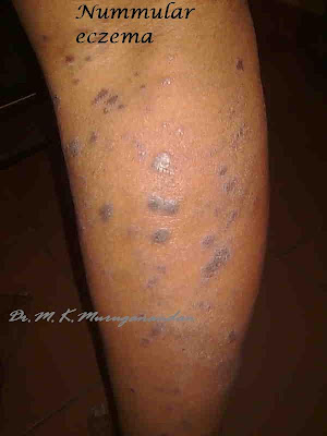 இதுவம் ஒரு வகை தோல் நோய் - நுமலர் எக்ஸிமாNummular eczema  Nummular+eczema+1