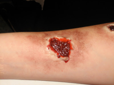 Gunshot Entry Wound