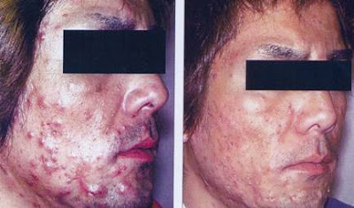 Terapia fotodinamica em dermatologia 84 Terapia fotodinamica em dermatologia 34