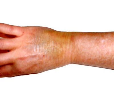 jaguarjulie bruised and injured hand 5 days later