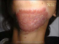 Tuberculose da pele