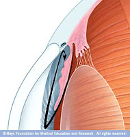 Glaucoma de ângulo aberto