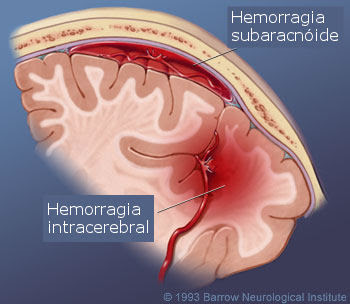 AVC hemorrágico