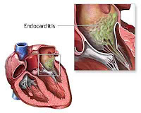 Endocardite