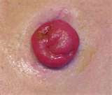 stoma