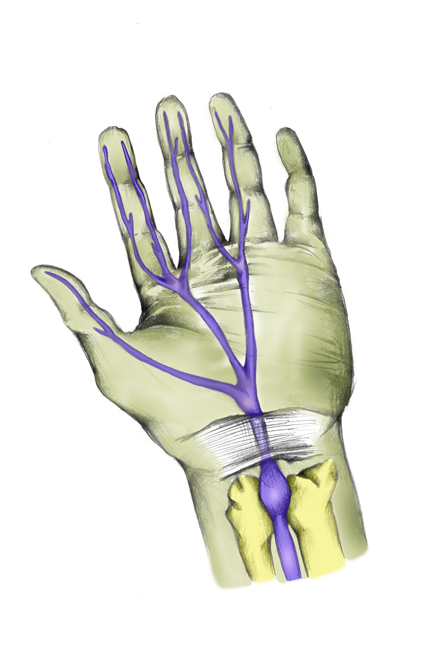 [carpal+tunnel..jpg]