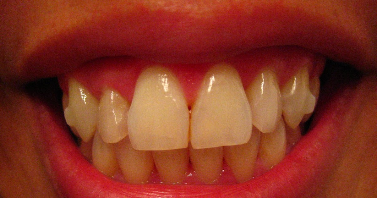 Thy's Invisalign Journey 3rd Refinement Trays