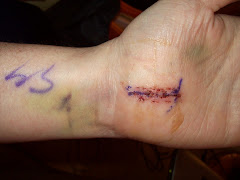 Left hand Carpal Tunnel/Guyon's Canal Incision