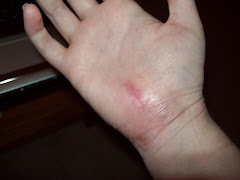 6 weeks post-op