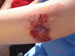 ANSWER: Shelby, Heather AND Brandon got in bike accidents in 2004