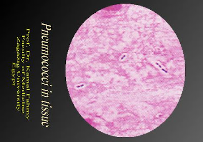 اطلس الميكروبيولوجي -1- Pnemococci+in+tissue
