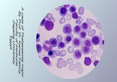 اطلس علم الدم -1- Thalassaemia+major+Anemia