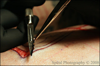 Cryosurgery Tattoo Removal-Easy way to remove22