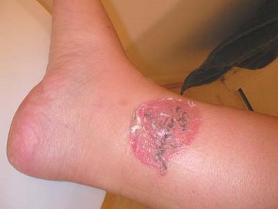 Dermabrasion tattoo removal is the most effective method of tattoo removal. Dermabrasion tattoo removal is the most effective method of tattoo removal.