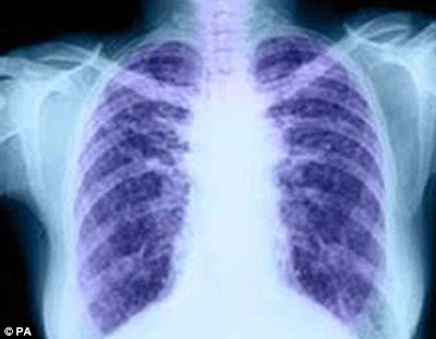 Chest X-ray