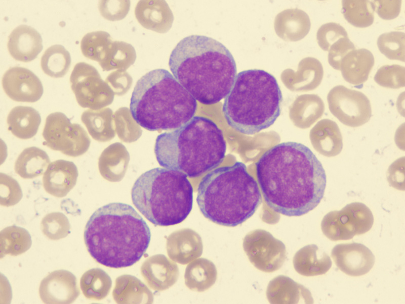 [Aml-Leukemia.jpg]