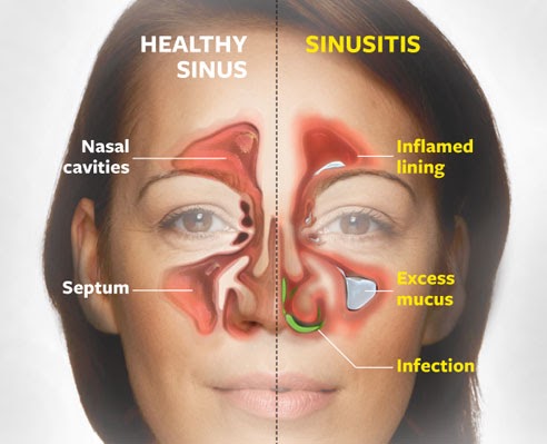 sinusitis chronic mri