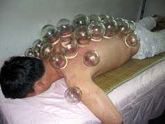 man getting "CUPPING" body therapy