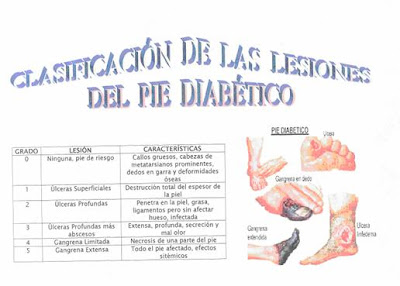 DiaBeTeS.com: Complicaciones: Pie diabetico DiaBeTeS.com: Complicaciones: Pie diabetico