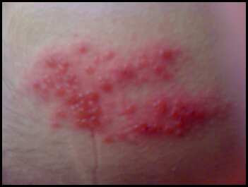 herpes utslett herpes utslett