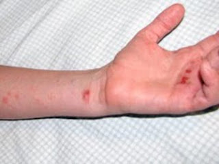 Las causas de la enfermedad atopicheskogo de la dermatitis