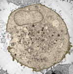 what is prostate cancer what-is-prostate-cancer