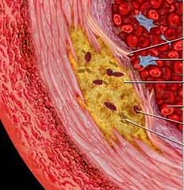 [atherosclerosis-6782320.jpg]
