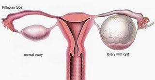 ovarian cyst How To Treat Or Cure Hemorrhagic Ovarian Cysts? Complex Ovarian Cysts